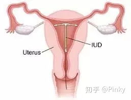 避孕环的奇妙之旅，温馨日常背后的历史印记