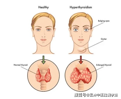 明星背后的故事，甲亢影响与应对策略揭秘